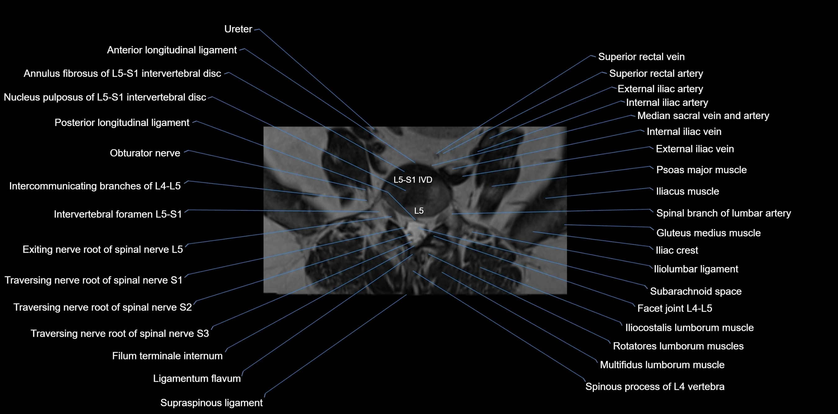 MRI sacrum, coccyx and sacroiliac joint axial cross sectional anatomy 3T  radiology  image-img-00001-00002.webp